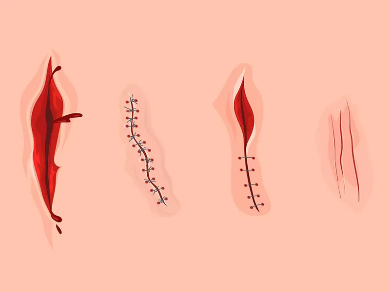 Superior Cosmetic Outcomes