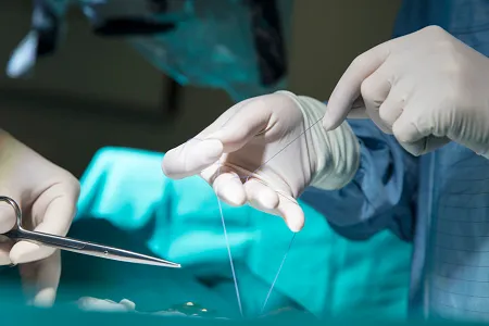 Absorbable Ligation Clips in Laparoscopic Surgery: Technology and Clinical Rationale